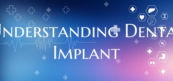 Understanding Dental Implant