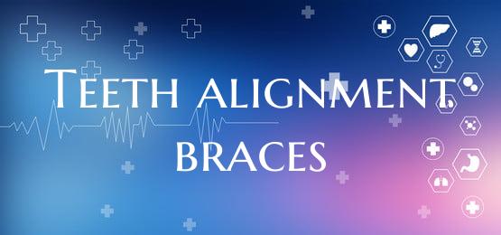 Teeth alignment braces